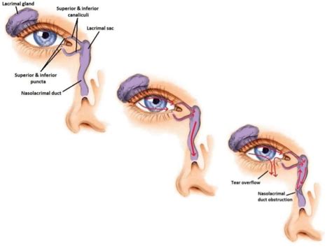 Endoscopic DCR – ENT Centre Mumbai