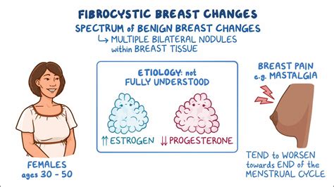 Fibrocystic breast changes: Clinical sciences - Osmosis Video Library