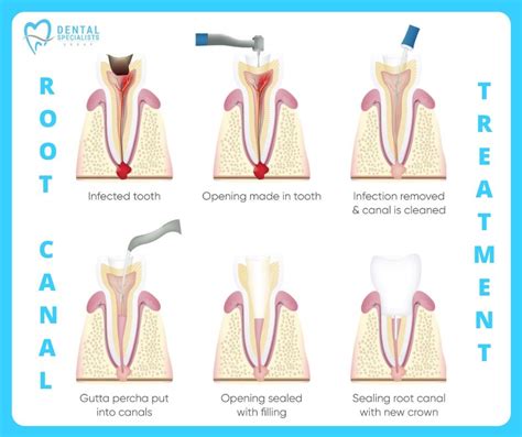 What is an endodontic treatment and why do teeth need it?