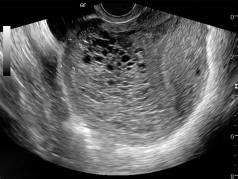 Hydatidiform Mole - Gynecology - Medbullets Step 2/3