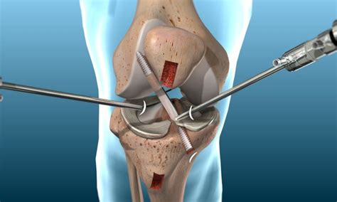 ACL Reconstruction | Dr. Patrick Chin Orthopedic Surgeon Vancouver