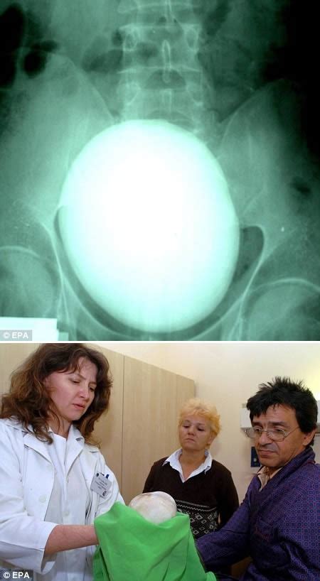 World's largest ever recorded kidney stone