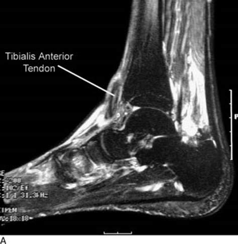 Tibialis Anterior Tendon Mri