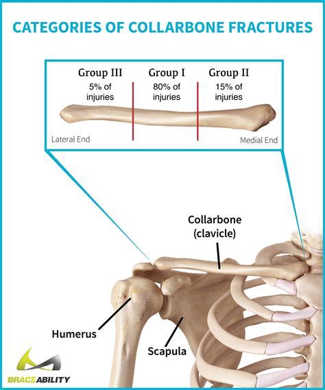 Clavicle Fractures | Broken Collarbone Symptoms, Causes & Treatment