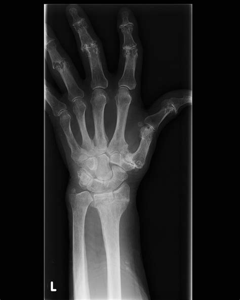 frykman classification of distal radial fractures | pacs