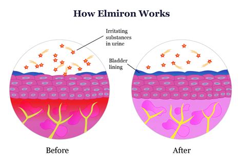 Elmiron Vision Loss Lawsuit - Luff Law Firm, PLLC