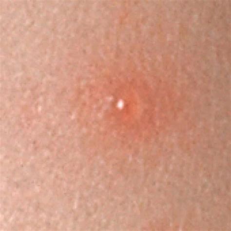 9 Common Rashes That Can Blister: Chicken Pox Rash On Back, Types Of ...