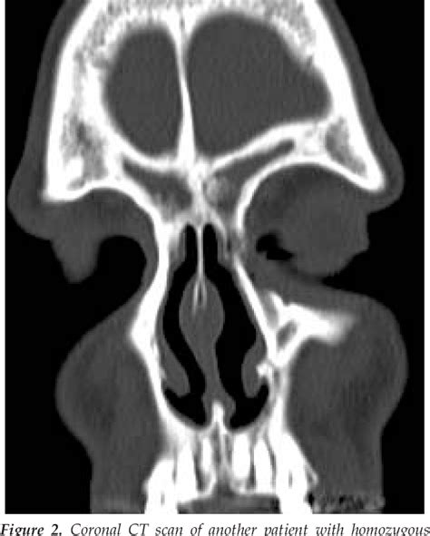 Figure 2 from The Delta F508 Mutation in Cystic Fibrosis and Impact on Sinus Development ...