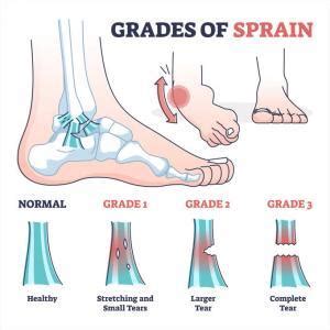 Ankle Sprains: Inversion vs. Eversion - JOI and JOI Rehab