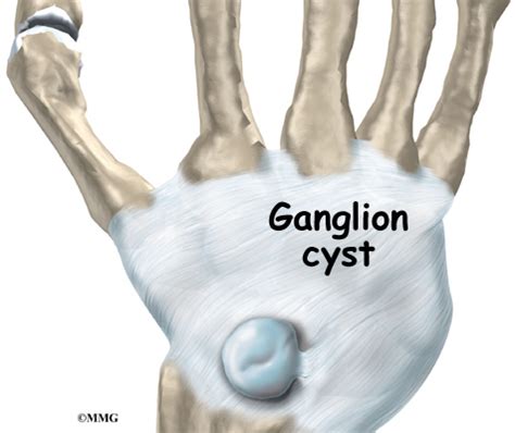 Ganglions of the Wrist - James Seeds, MD, Orthopedic & Sports Medicine ...