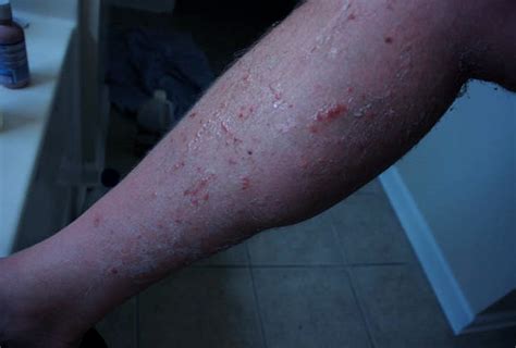 Chiggers Rash Pictures