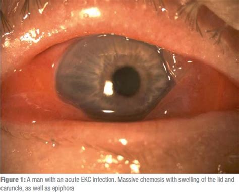 Epidemic Keratoconjunctivitis (08.07.2011)