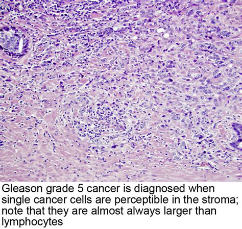 Pathology Outlines - Gleason grading