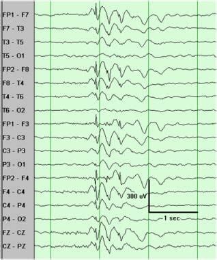 Generalized Seizure Eeg