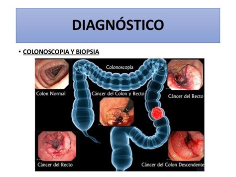 Cáncer de colon, recto y ano