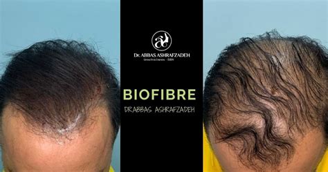 Biofibre Hair Transplant In Dubai - Dr Abbas Ashrafzadeh