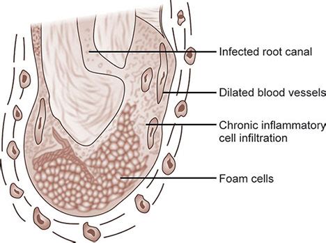 Periapical Granuloma Histology