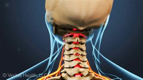 What Is Cervical Radiculopathy? | Radiculopathy, Cervical radiculopathy, Neck arthritis