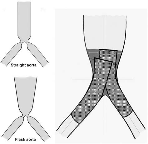 Figure 3 from Kissing stent reconstruction of the aortoiliac ...