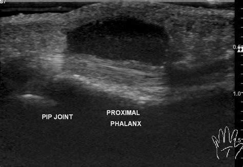 Giant Cell Tumor Of Tendon Sheath Finger