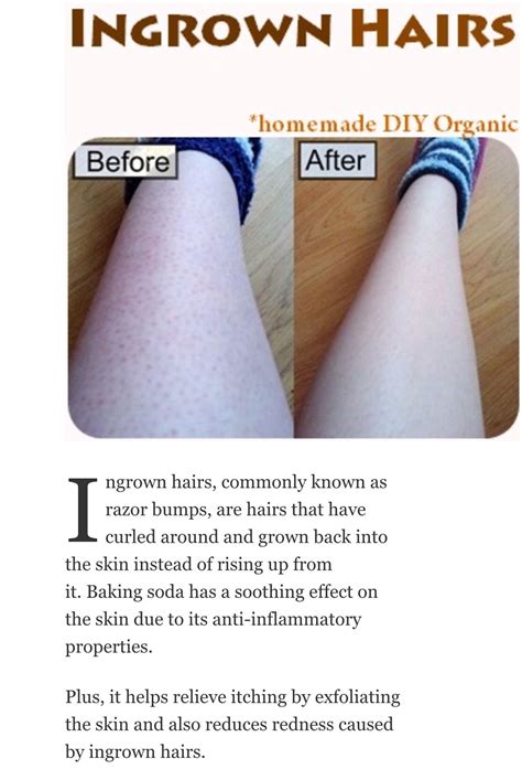 How To Exfoliate Legs With Ingrown Hairs