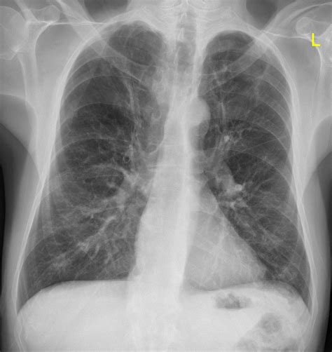 What Does Copd Look Like On Chest X Ray | Images and Photos finder