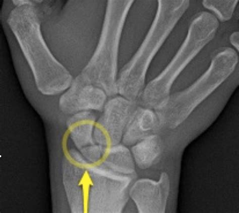 Scaphoid Fractures – Core EM