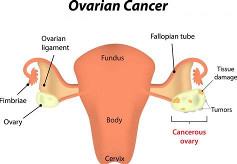 What Are the Different Types of Epithelial Cancer?