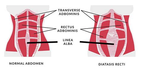 Before and After: Diastasis Recti - RYC®