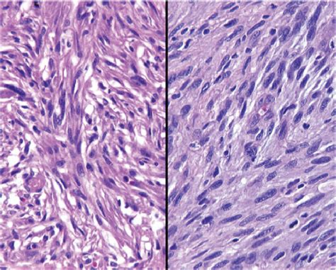 Laryngeal Spindle Cell Squamous Cell Carcinoma | Semantic Scholar