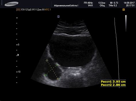 Diverticulum Of Bladder Ultrasound