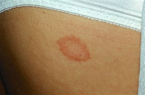 Pityriasis Rosada: What is it? Causes, Symptoms, Diagnosis and Treatment - Scope Heal