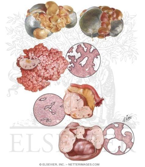 Epithelial Stromal Ovarian Tumors