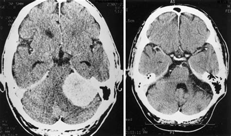 Meningiomas of the tentorial notch: surgical anatomy and management in: Journal of Neurosurgery ...