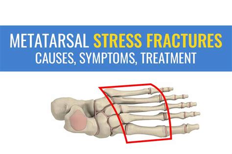 Metatarsal stress fractures – Causes, symptoms, and treatment