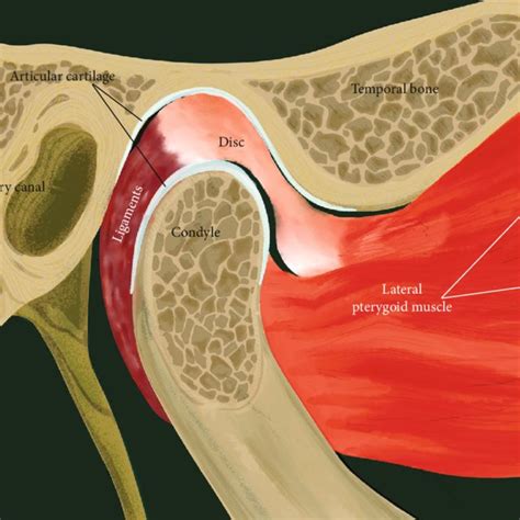 TMJ anterior disc displacement without reduction (ADDwoR). | Download ...