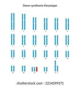 Translocation Down Syndrome Karyotype