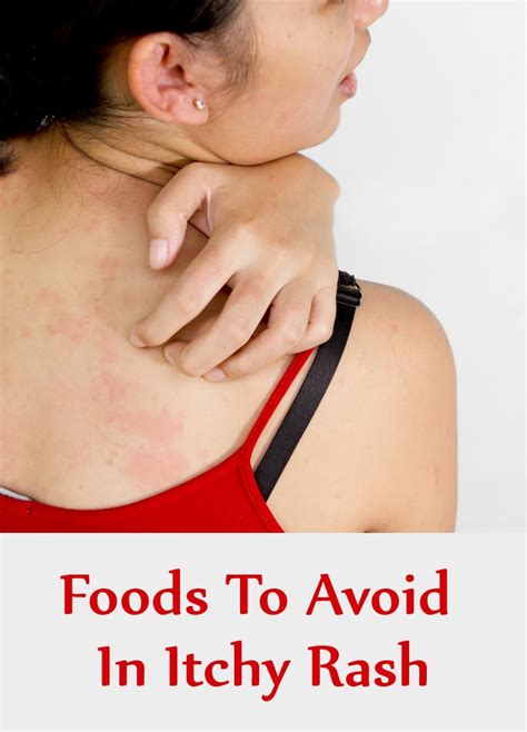 6 Foods To Avoid In Itchy Rash | Search Home Remedy