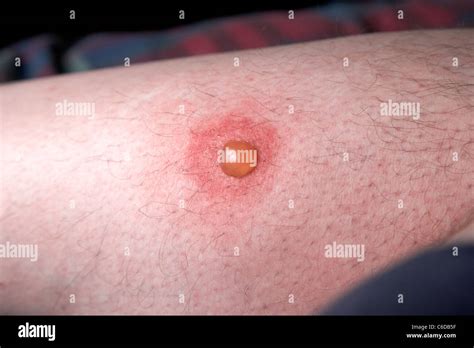 blister on a mans leg as a result of scratching a mosquito bite Stock Photo, Royalty Free Image ...