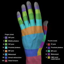 Hand Extensor Tendon Zones