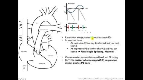 Splitting of the Second Heart Sound (S2) - YouTube