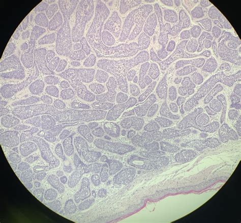 [Figure, Cylindroma Contributed by David Myers, MD] - StatPearls - NCBI ...