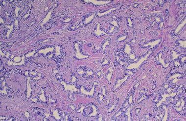 What are the histologic findings of infiltrating ductal carcinoma ...