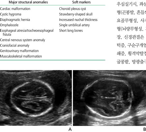 Trisomy 18 Fetal Ultrasound