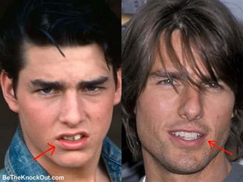 Tom Cruise Plastic Surgery Comparison Photos