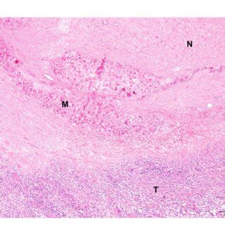 FIGURE E Histopathological picture of a spindle cell sarcoma of patient... | Download Scientific ...