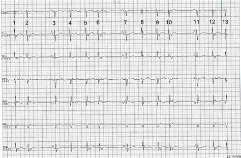 ECG Rhythms: Another irregular rhythm with a pattern