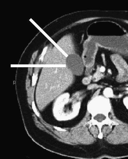 Percutaneous Cholecystostomy | Radiology Key