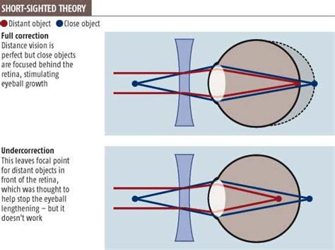 Is It Worse To Be Short Sighted Or Long Sighted - Thomas Dixon's Sight ...