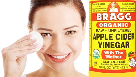 5 easy and quick ways to remove pimples - Home | Vinegar for acne, Apple cider vinegar remedies ...